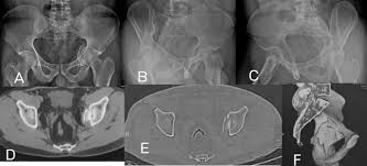 Unclassified acetabular fractures: Do they really exist?