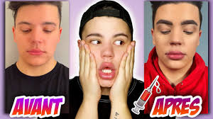 J'AI REFAIT MA BOUCHE 💉👄