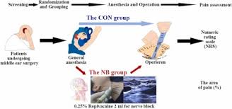 Image result for Ear Nerve Block