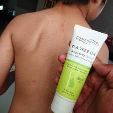 Makin ramai yang dijangkiti demam campak jika tahap suntikan vaksin semakin menurut. Demam Campak La Pulak Qhaliff Ben Ashaari