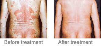 Uvb Home Phototherapy Is Even More Affordable For Everyone Uvb Lamps