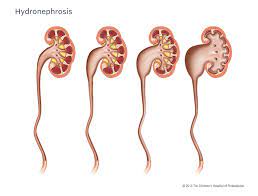 Hydronephrosis Urinary Tract Dilation Children S Hospital Of Philadelphia