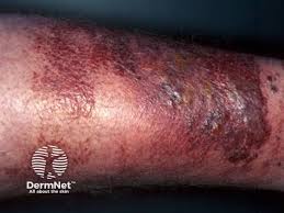 Image result for erysipel photos)