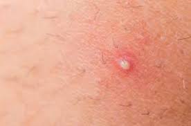 Lipoma adalah benjolan berisi lemak yang tumbuh tepat di bawah lapisan kulit dan merupakan masalah kesehatan yang awam. 6 Petua Hilangkan Bisul Di Badan Dengan Berkesan