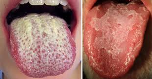 Do you want to get rid of your white tongue so that it looks pink again when you take a selfie? White Tongue Natural Treatment Causes How To Get Rid Of It David Avocado Wolfe