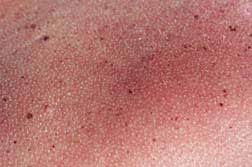 To cool the burn, carefully wipe off excess cream with a kleenex, apply olive oil with a cotton ball, wipe off with another kleenex, and then wash off with water. Icy Hot Hot Enough To Take Your Skin Right Off