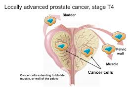 Although screenings for prostate cancer are one tool for early detecti. Locally Advanced Prostate Cancer Kenneth J Pienta