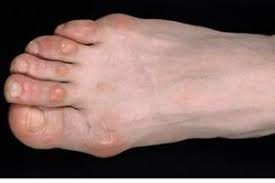How To Treat Corns With Lemons Corn On Toe Toe Corn Removal Corn Removal
