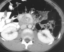 Image result for Intestinal Malrotation