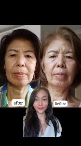Treatment terhemat dan ter-aman, tanpa suntik, tanpa botox, tanpa operasi.,  Baru 8 hari sudah terlihat hasilnya 😍 , Tetapi ini bukan hasil akhir,  karena 2-3 bulan wajah masih akan terus makin kencang ...