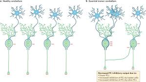 It is a common movement disorder that most often affects the hands but can also occur in the arms, head, vocal cords, torso, and legs. Essential Tremor Pathology Neurodegeneration And Reorganization Of Neuronal Connections Nature Reviews Neurology