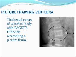 It is a result of disorganized new cortical bone formation after excessive osteoclastic activity causes the resorption of normal bone. Radiographic Appearances For Bone Tumors Osce Flashcards Quizlet