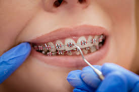 If for any reason you don't feel comfortable dealing with the situation. Putting On Braces How Are Braces Put On