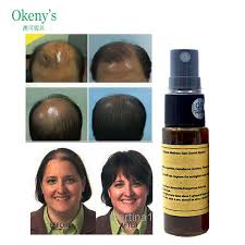Minoxidil can enhance the size of the follicle so. Fashionnfreak Best Treatment For Hair Falling Out