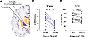 Image result for Pallidotomy