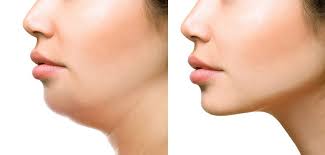 Because there are several different approaches, double chin surgery varies in cost, from $1,200 to $12,700, according to the american board of cosmetic surgery. What To Do After Neck Lipo Westside Face