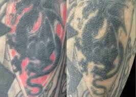 A successful tattoo removal starts with preparation. Picosure Tattoo Removal Anna Avaliani Md Cosmetic Laser Surgery Anna Avaliani Md Cosmetic Laser Surgery