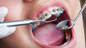 Maybe you would like to learn more about one of these? Ngeri Wanita Ini Alami Demam Hingga Bibirnya Bengkak Gara Gara Behel Palsu