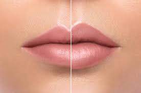 Lip blushing with kissum micro pigment color and dr pen from viana care. Hyaluron Pen Lip Fillers Beauty F X