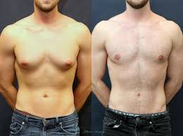 Image result for Gynecomastia