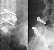 Percutaneous Translaminar Facet Screw Fixation | Neupsy Key