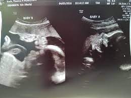 28 Weeks Pregnant With Twins Tips Advice How To Prep Twiniversity