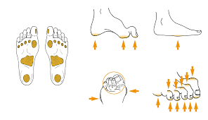 Image result for IDSA Diabetic Foot Wound Classification