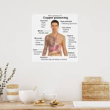 Image result for Copper Poisoning