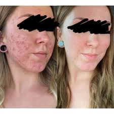 4 månader på Spironolakton : r/acne