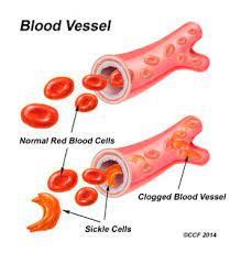 Sickle cell disease (scd) and its variants are genetic disorders resulting from the presence of a mutated form of hemoglobin, hemoglobin s (hbs) 1, 2 (see the image below). Sickle Cell Anemia Symptoms Causes Treatments