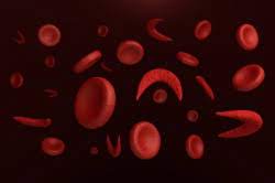 The term was first proposed in patients with sickle cell disease by charache et al in 1979 as a description for the combination of chest pain, fever, increased leukocytosis, and appearance of a new shadow on a chest radiograph. Gentechnik Zur Behandlung Der Sichelzellanamie Healthcare In Europe Com