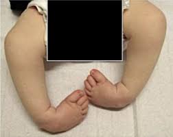 These conditions include arthrogryposis (a joint problem) and spina bifida (a neural tube disorder). Club Foot Treatment Singapore Foot Deformity Correction