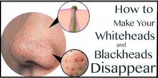 They do not get oxidized. How To Get Rid Of Blackheads And Whiteheads