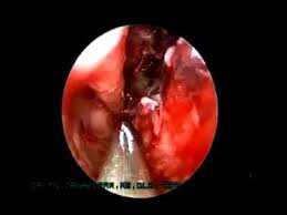 Download lagu buang ulat resdung (2.7mb) dan streaming kumpulan lagu buang ulat resdung (2.7mb) mp3 terbaru di hasil diatas adalah hasil pencarian dari anda buang ulat resdung mp3 dan menurut kami yang paling cocok adalah buang ulat resdung. Resdung Dan Telinga Petua Ubati Resdung Paling Mujarab