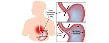 Image result for Pediatric Reflux