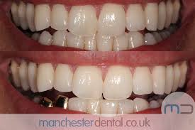Dental implant prices depend on: Gold Teeth Manchester Manchester Dental