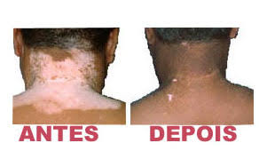 Resultado de imagem para vitiligo tem cura