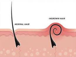 Shaving, plucking or any other hair removal method can make the irritation worse and introduce bacteria to the ingrown hair follicle 4. Ingrown Hair Ingrown Hair Labia Majora Pictures
