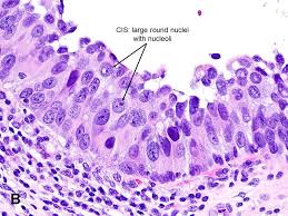 This controversy also depends on the exact cis in question (i.e. Urothelial Carcinoma In Situ American Urological Association