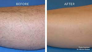 After a few sessions, the root doesn't grow back'and, voila, hair stops growing. Best Laser Hair Removal In Dubai Abu Dhabi Hair Reduction Uae Cost
