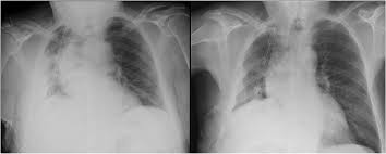 Heart failure, pneumonia) or a chronic condition already known to some patients with fibrous or loculated effusions may also require intrapleural fibrinolytic therapy (e.g. Agreement Between Chest Ultrasonography And Chest X Ray In Patients Who Have Undergone Thoracic Surgery Preliminary Results Multidisciplinary Respiratory Medicine Full Text