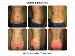 Maybe you would like to learn more about one of these? Laser Liposuction Surgery New Radiance Cosmetic Center Of St Lucie