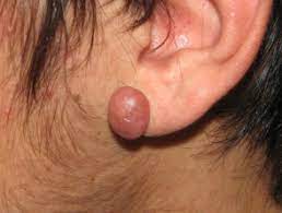 Body Piercing Dermnet Nz