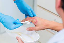 How Do I Heal A Burn Quickly?