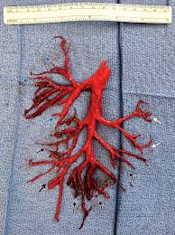 Usa Mann Hustet Sich Teil Der Lunge Aus Dem Leib Das Bild Ist Nichts Fur Schwache Nerven Watson