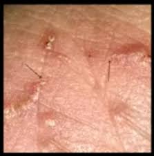 Image result for scabies on genitals