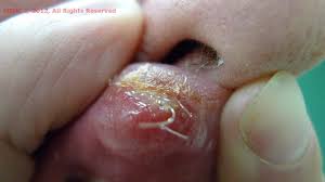 Image result for Primary Syphilis