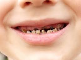 Rotten Teeth Children Clinica Dental Tenerife Sur