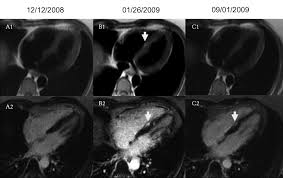 More specifically, it is described as. Figure 2 Subendocardial Ischemia And Myocarditis In Systemic Lupus Erythematosus Detected By Cardiac Magnetic Resonance Imaging The Journal Of Rheumatology