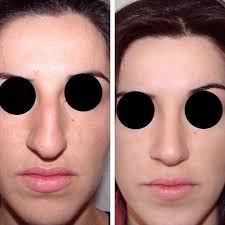 Before And After Bulbous Nose Rhinoplasty Example Photos Bulbous Nose Rhinoplasty Rhinoplasty Before And After